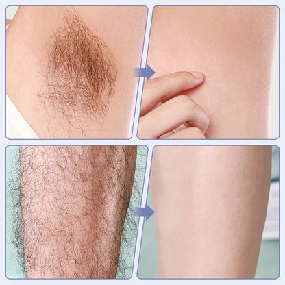 Laser IPL Hair Removal Device With Ice-Cooling Contact