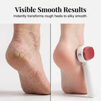Double-Sided Foot Scraper for Callus Removal